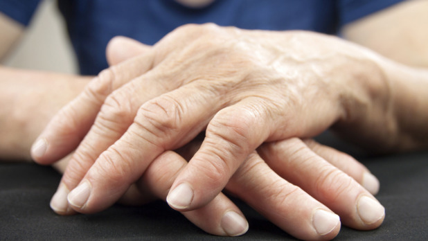 Hand Of Woman Deformed From Rheumatoid Arthritis