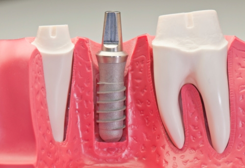 implantaten_499x342