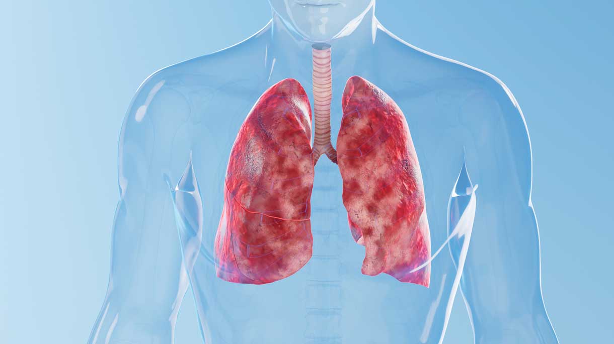 cystic fibrose