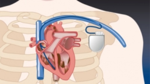Pacemaker2_320x320