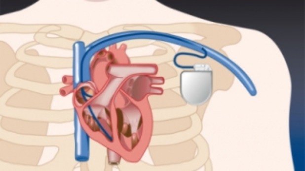 Pacemaker2_320x320