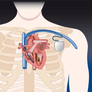 Pacemaker2_320x320