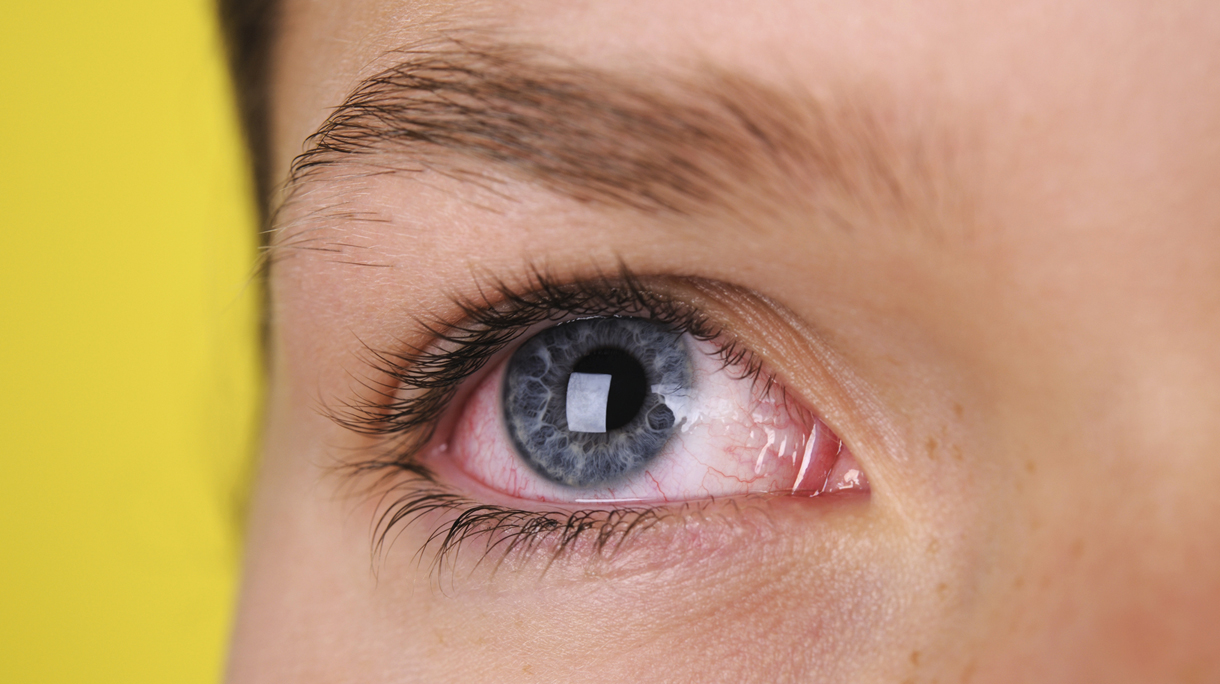 A close-up of blue eye that is bloodshot