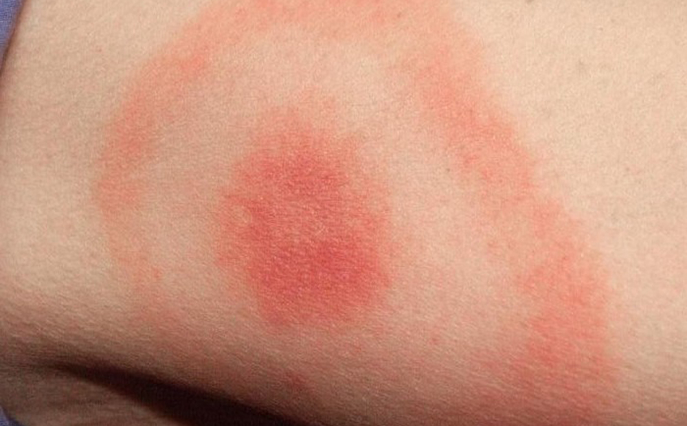 ziekte_van_Lyme_320x320_0