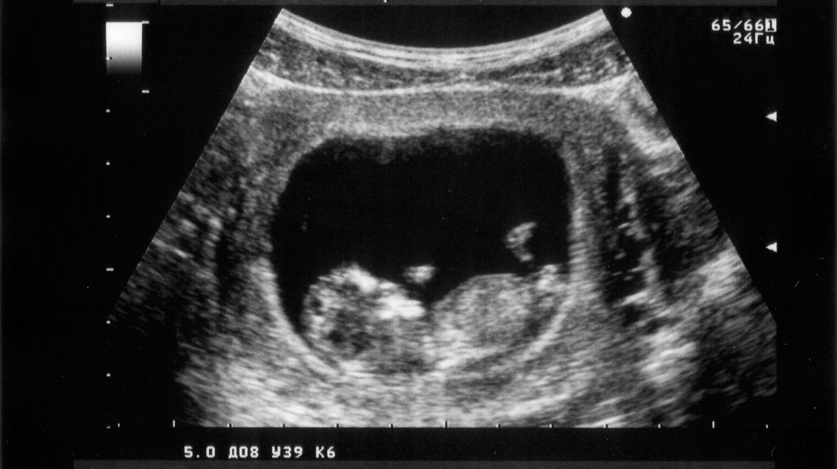 foetus