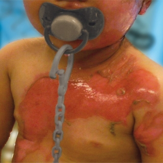 brandwonden_baby_320x320_0
