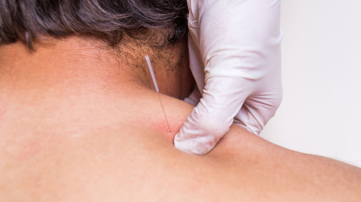 dryneedling