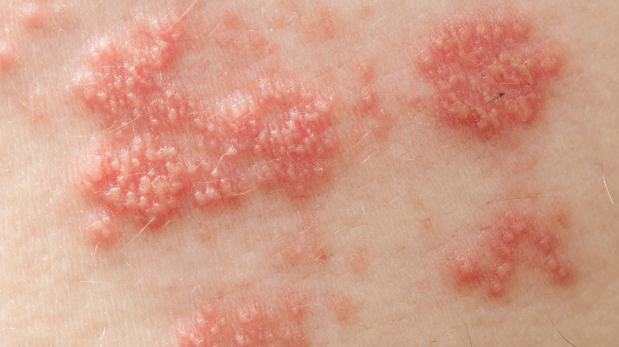 shingles-picture-id177384156