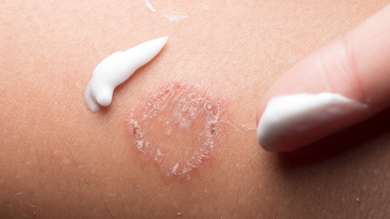 Ring Worm infection, Dermatophytosis