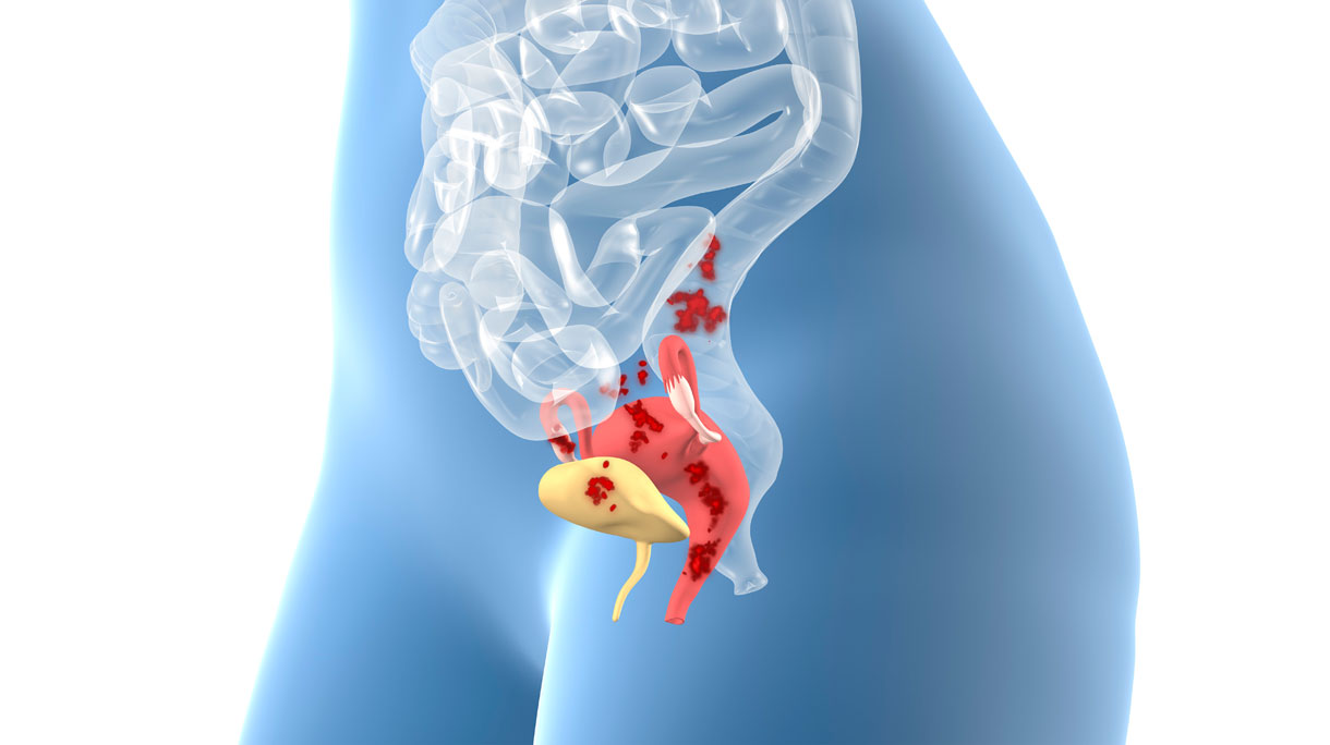 Endometriose