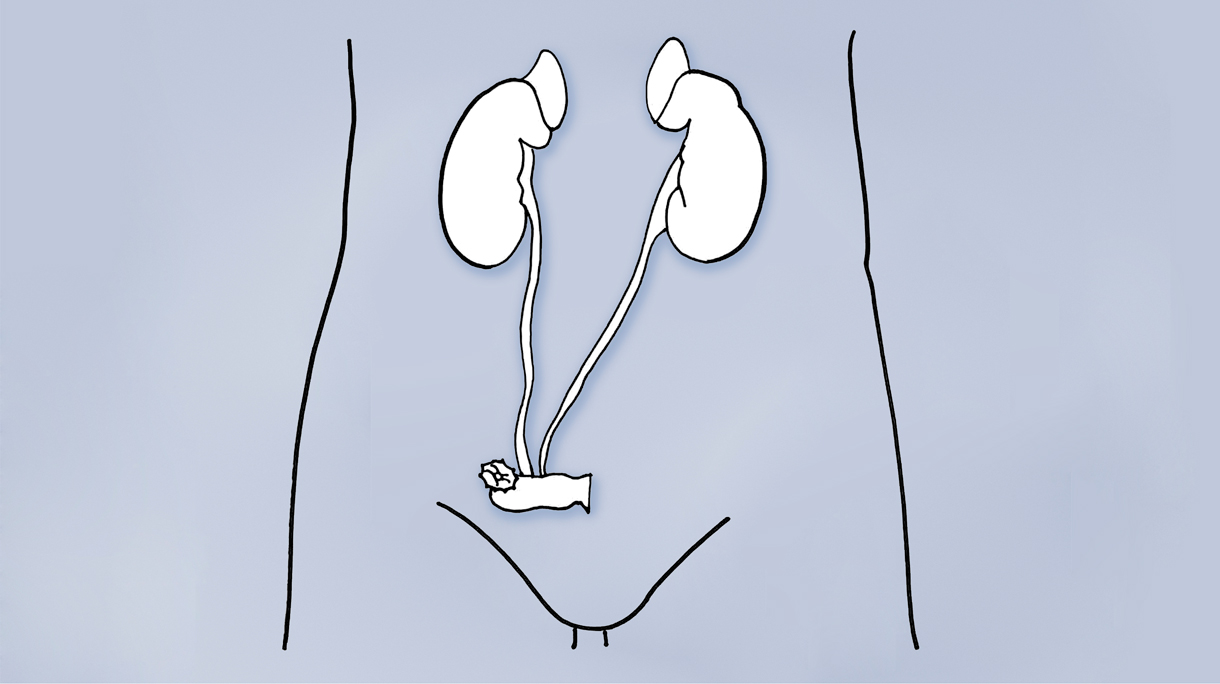 urinestoma