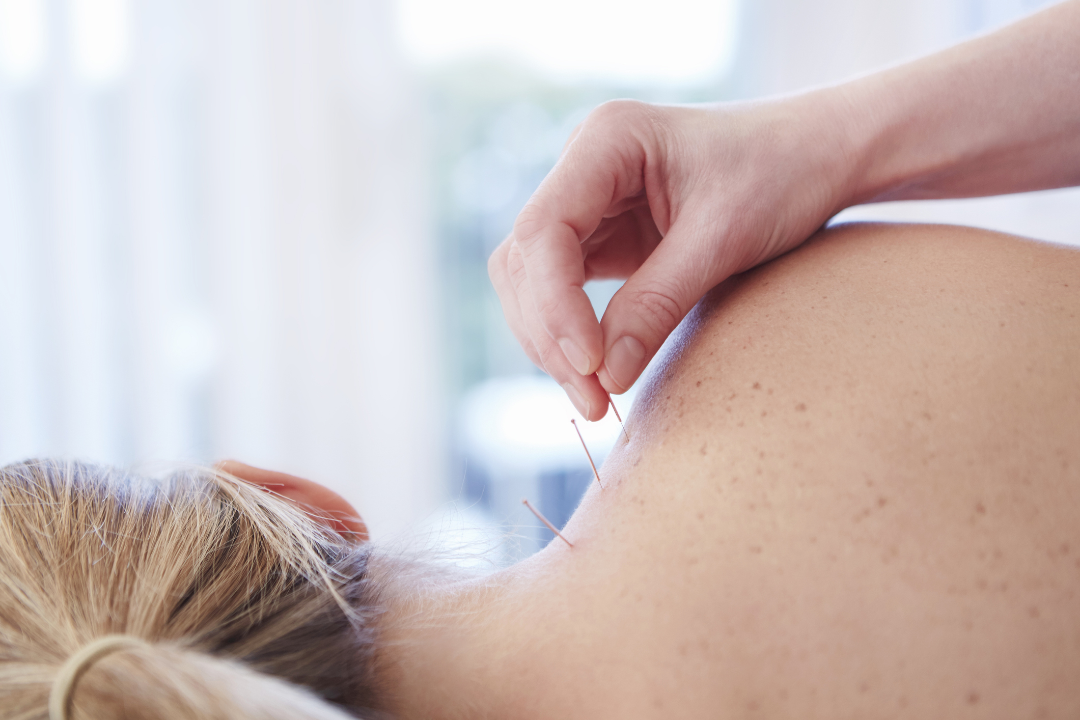 Woman receiving acupuncture in shoulder