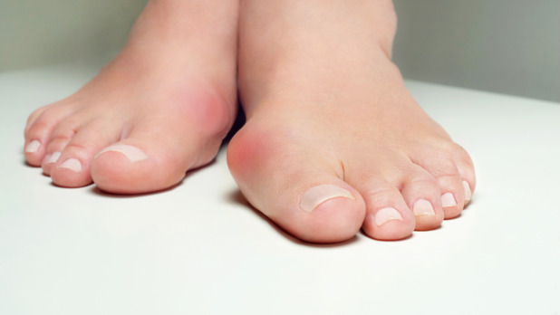 Hallux valgus, bunion in woman foot on white background