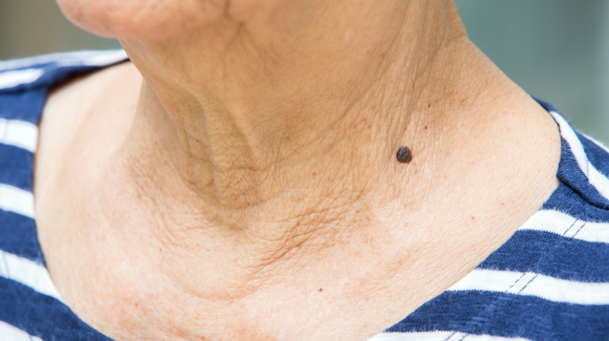 Black mole on senior woman’s neck, Medicine, Close up