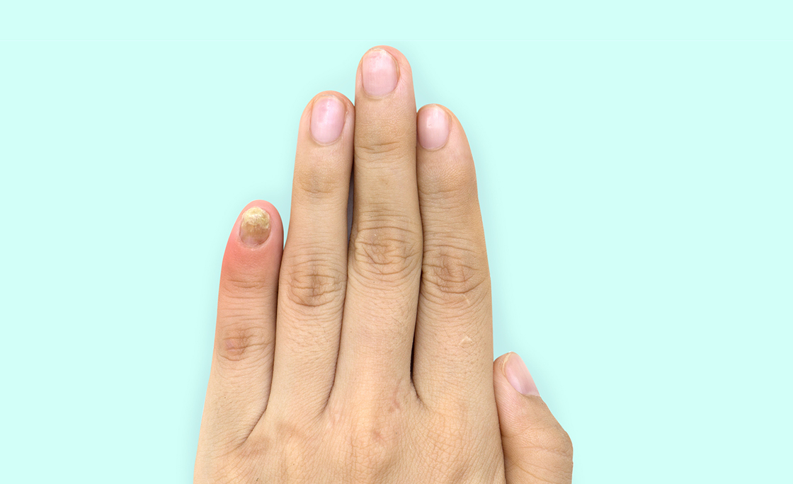 Close up of nail fungus infection on the little finger. Human hand suffering from fungus infection. Onychomycosis with fungal nail infection on nail isolated over soft background. Clipping path.