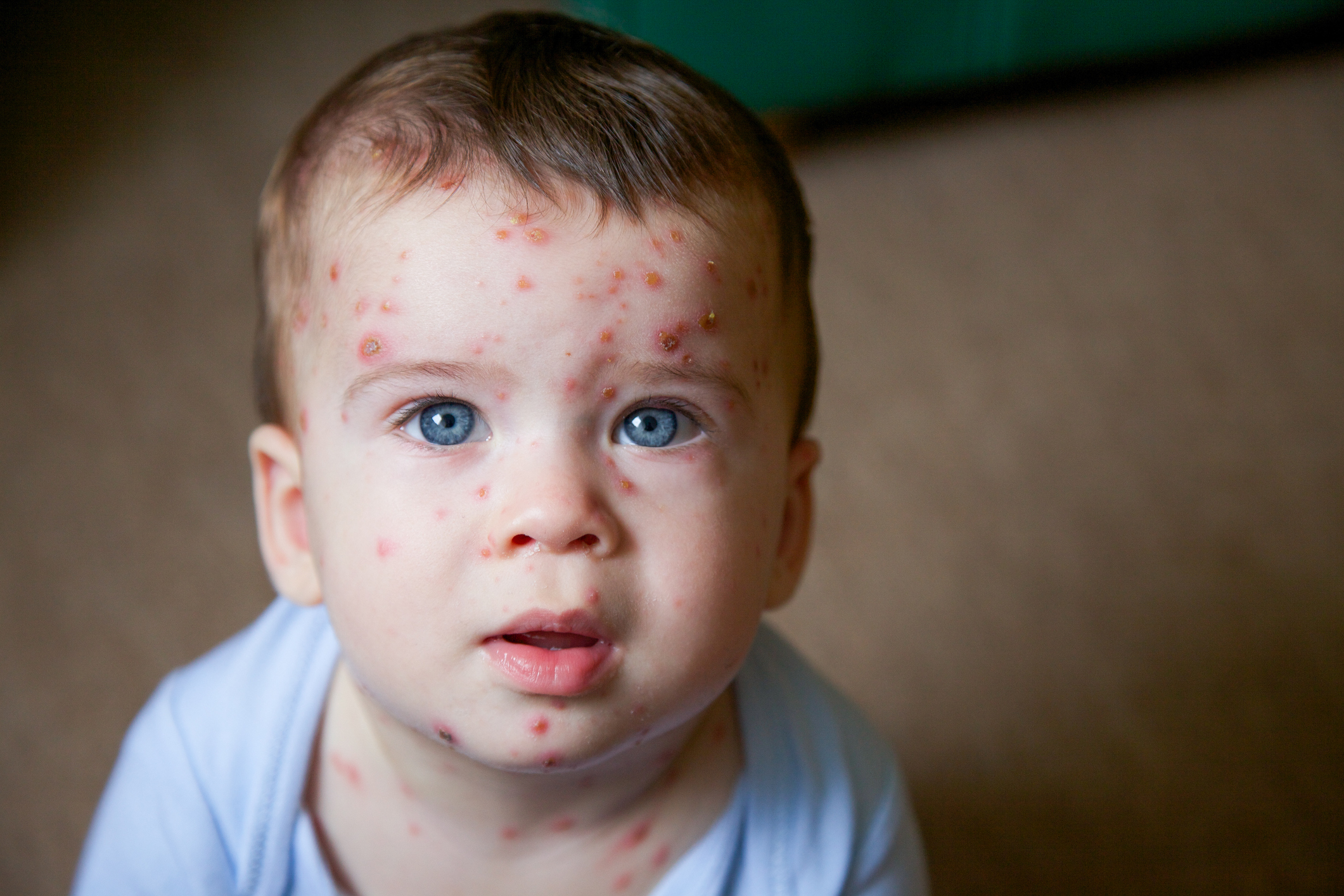 Young toddler with chickenpox