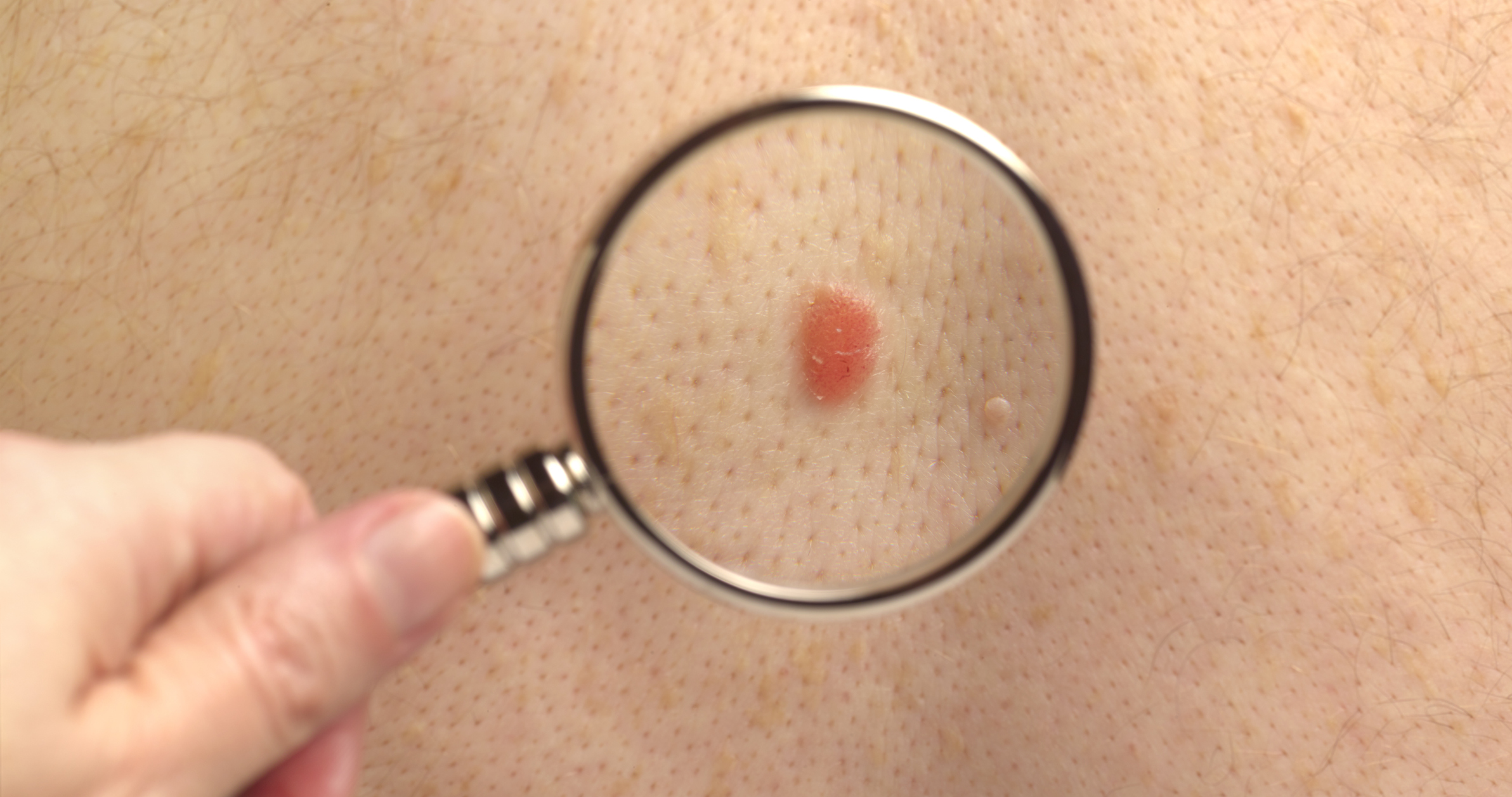 Doctor checking melanoma