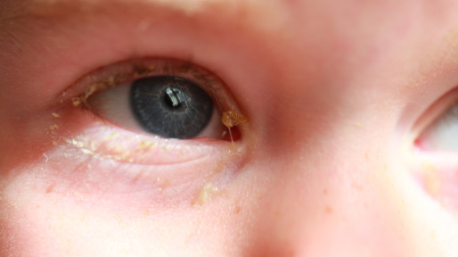 purulent conjunctivitis in children