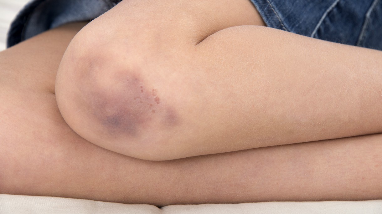 MODEL RELEASED. Girl with a bruised knee.