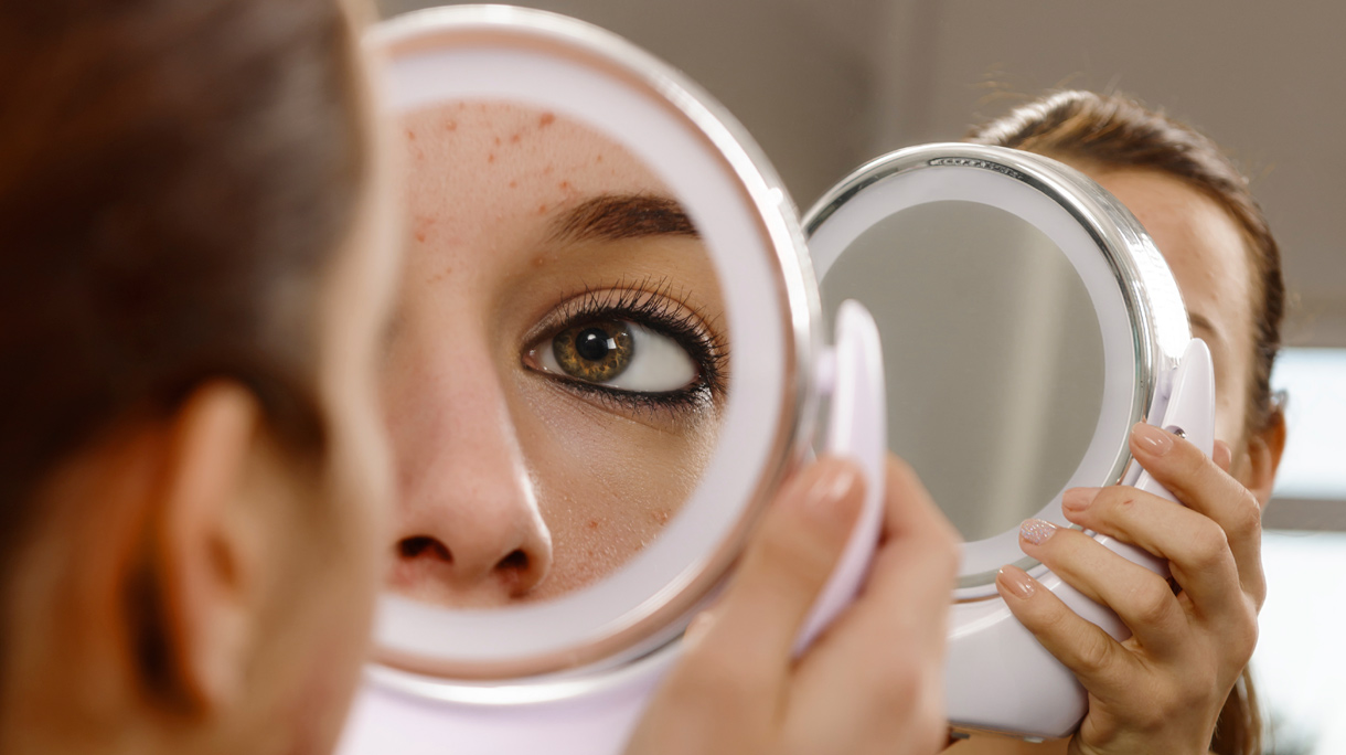 rosacea