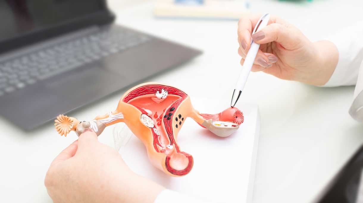 endometriose