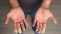 Man met witte gevoelloze vingers