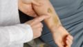 blauwe plek op arm van oudere vrouw