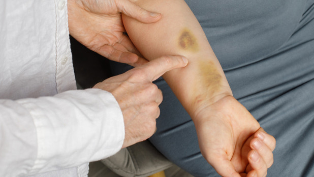 blauwe plek op arm van oudere vrouw