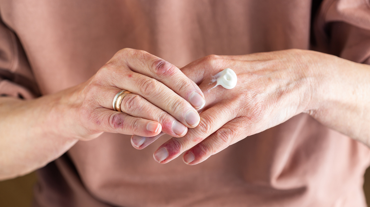 oudere vrouw smeert hormooncreme op handen