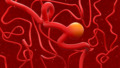 3D beeld van een aneurysma in de hersenen