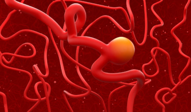3D beeld van een aneurysma in de hersenen