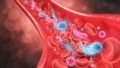 Sepsis