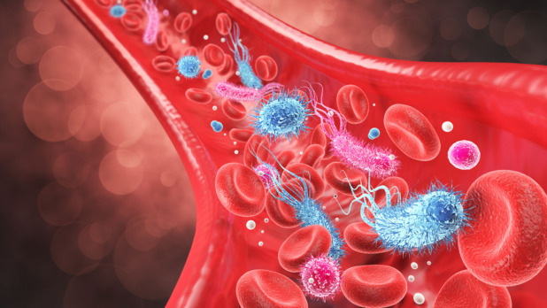 Sepsis